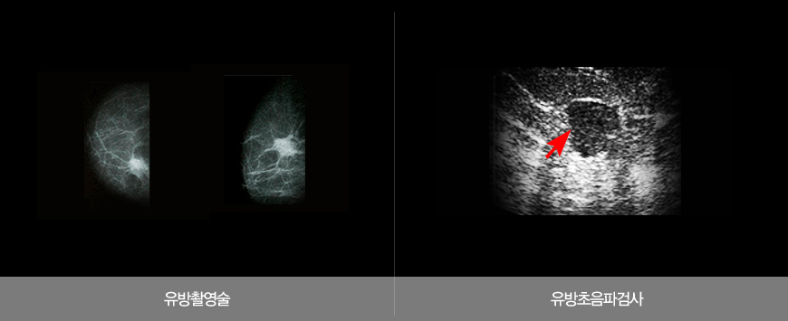 유방암 전문진단