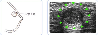 섬유선종