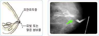 유관 유두종