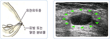 물혹 또는 낭종